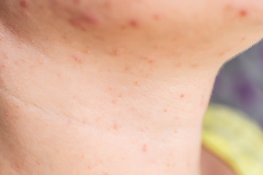 Red acne and a rash on a girl's face and neck, macro, hormone
