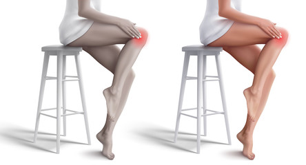Bright and discoloured Illustrations with woman that sitting on the stool, rubbing her knee and suffering from pain in knee. Vector illustration isolated on white background. 
