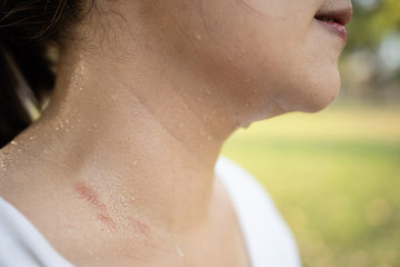 Female neck with sweat on skin,asian woman with atopic allergy skin with red spots caused by...