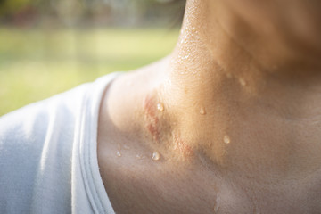 Closeup of wet female throat with water drops or sweat on skin,symptom of panic disorder, lymphoma...