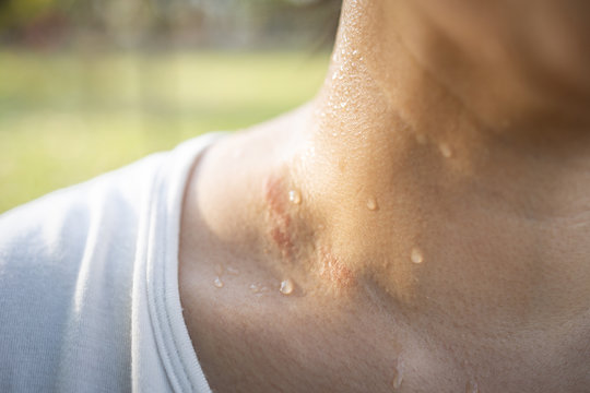 Closeup Of Wet Female Throat With Water Drops Or Sweat On Skin,symptom Of Panic Disorder, Lymphoma Or Obesity, Sweaty Asian Woman After Gym Workout Or Hot Weather,sweating, Hyperhidrosis Concept