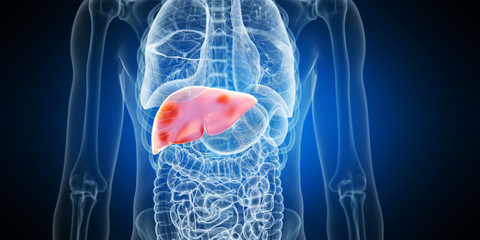 3d rendered medically accurate illustration of liver tumors