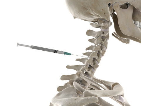 3d rendered medically accurate illustration of a spine injection