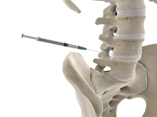 3d rendered medically accurate illustration of a lumbar spine injection - obrazy, fototapety, plakaty
