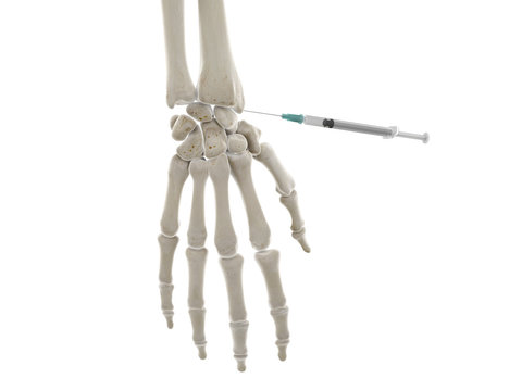3d rendered medically accurate illustration of a wrist injection