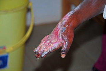 The serious burns to a hand of a child African-Tanzania-Africa
