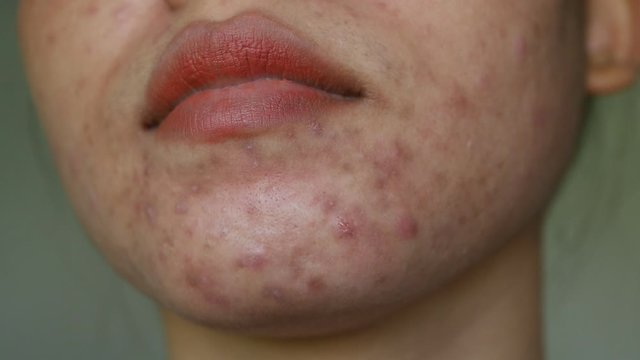 Close up skin problem and acne on Chin and face of women. 