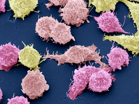 Cancer cells, SEM
