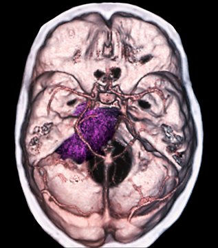 Benign brain tumour, CT scan