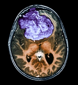 Benign brain tumour, CT scan