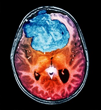 Benign brain tumour, CT scan