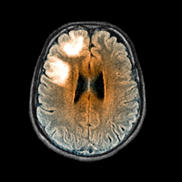 Leukoencephalopathy, MRI scan