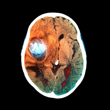 Aneurysm, CT scan