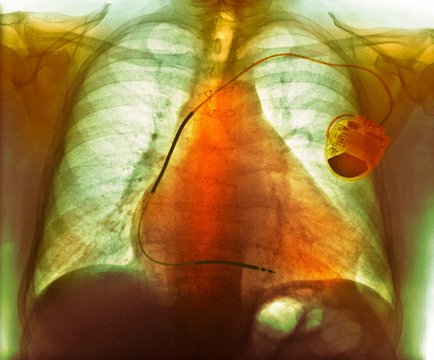 Pacemaker in heart disease, X-ray