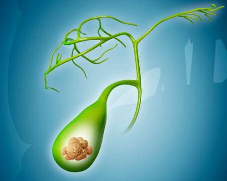Gall stones, illustration