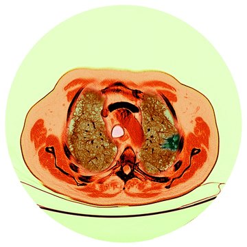 Lung cancer, CT scan