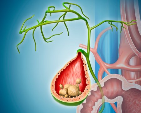 Gall stones, illustration