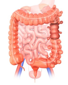 Diverticulitis, illustration