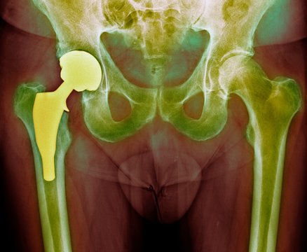 Total hip replacement, X-ray