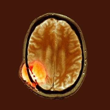 Brain cancer after surgery, MRI scan
