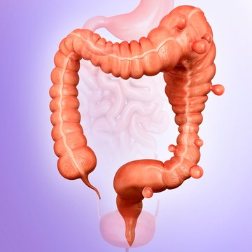Megacolon and diverticulitis
