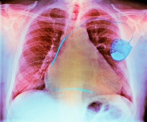 Pacemaker in heart disease, X-ray