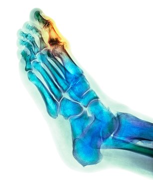 Degenerative foot deformation, X-ray