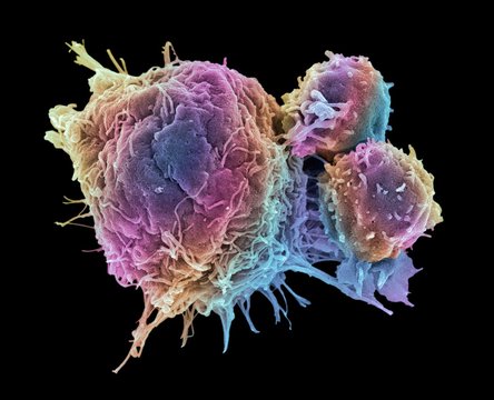 Cancer cell and T lymphocytes, SEM