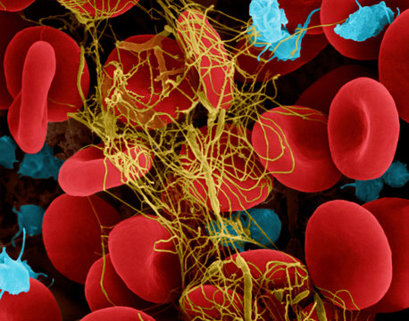 Red blood cells trapped in a fibrin blood clot, SEM