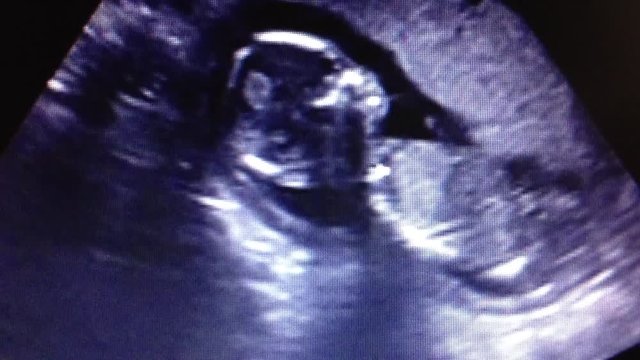 Ultrasound sonogram of a human fetus developing in the mother's womb.