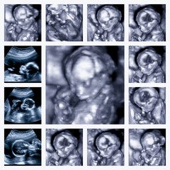 Collage of 3d Ultrasound of fetus in fourth month pregnancy