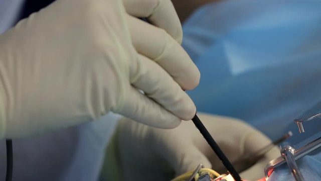 In modern clinic under deep anesthesia, using latest devices patient removes glands, cold plasma method, cuts swelling in throat, doctor works with new probe, close-up, new medical technologies