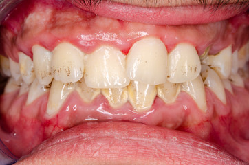 entzündetes zahnfleisch durch mangelnde mundhygiene