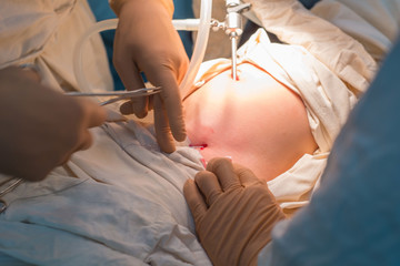 Close up of laparoscopic surgery in a sterile operating room. Percutaneous suturing of the inner...
