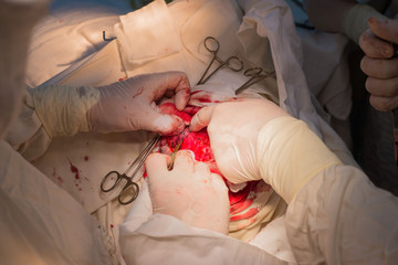 view from above. A close-up of the stages of a childs neurosurgical operation, the installation of...