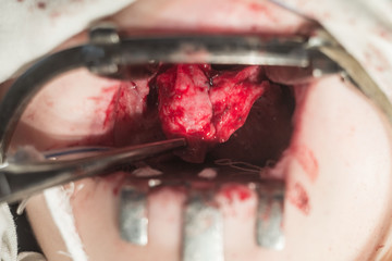 one of the stages of surgery for cleft palate in children. Mouth open with conservative, bloody...