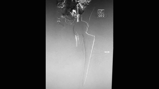 Angiography of left femoral artery with prosthetic left hip