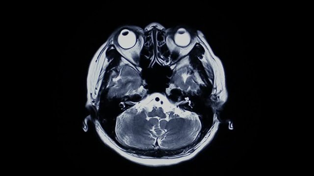 MRI brain scan on black background