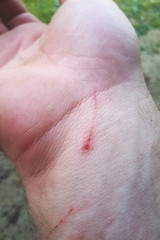 Fototapeta premium A wound on old woman wrist made scar on skin of body.