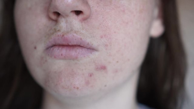 Depressed girl with acne problem, Girl checking her face in the mirror, skin with enlarged pores, acnes, examining it. The concept of caring for problem skin, aging, teenage.