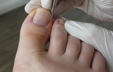 Podiatry, Chiropodist, medical foot care, podiatrist, ingrown toenail, fix an ingrown toenail