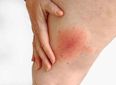 Wanderröte durch eine Zecke übertragene Lyme-Borreliose Erkrankung am Bein einer Frau. Borreliose Erkrankung durch einen Zeckenbiss am Oberschenkel