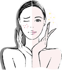 女性　頬のニキビ　ビフォーアフター