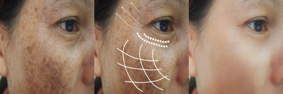 Image before and after anti-aging wrinkles dark spot melasma pigmentation skin facial treatment and face lift rejuvenation of Asian woman.Problem skincare and beauty concept.
