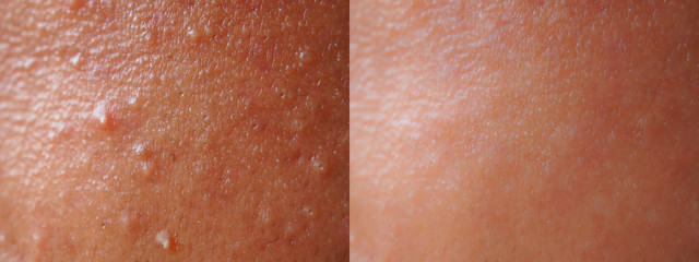 Closeup skin face texture before and after facial treatment problem of spot acne blackheads on...