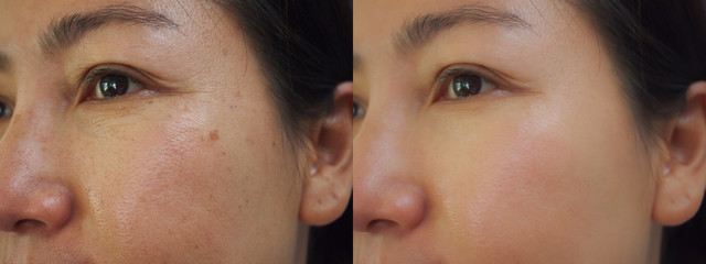 Image before and after treatment rejuvenation surgery on face asian woman concept.Closeup wrinkles...