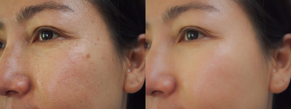 Image before and after treatment rejuvenation surgery on face asian woman concept.Closeup wrinkles dark spots pigmentation skin on face asian woman.