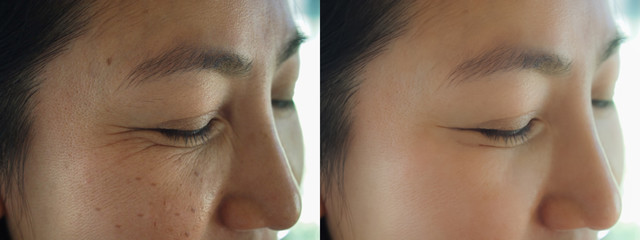Image before and after treatment rejuvenation surgery on face asian woman concept.Closeup wringkles...