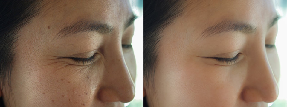 Image before and after treatment rejuvenation surgery on face asian woman concept.Closeup wringkles dark spots freckles pigmentation skin on facial of female.
