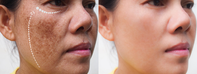 Image before and after anti-aging dark spot melasma pigmentation skin facial treatment rejuvenation...